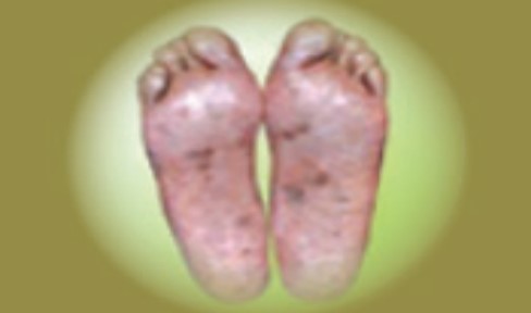 Athlete's Foot