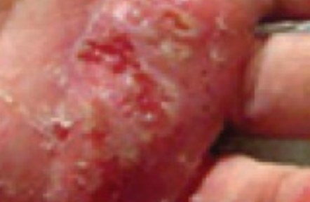 Eczema