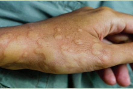 Hives