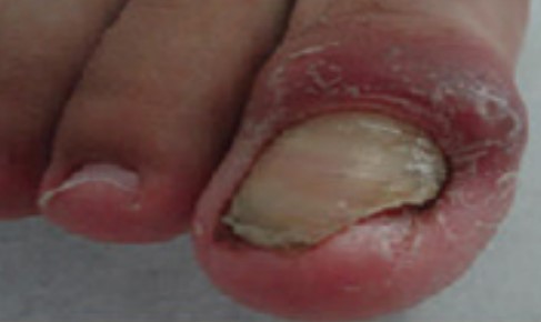 Paronychia