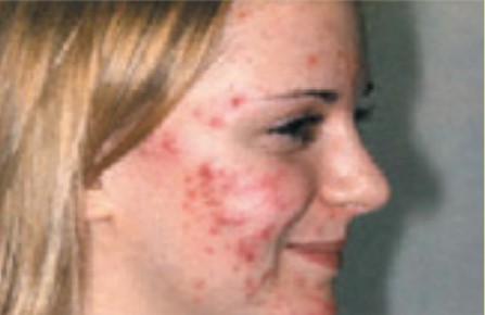 Pimple