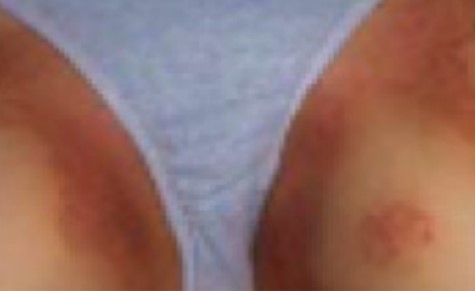 Tinea Cruris